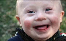 Down Sendromu Riski Riskleri ve Sonrası Down Sendromu Riski Riskleri ve Sonrası