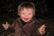 Mozaik Down Sendromu Belirtileri ve Tedavisi Mozaik Down Sendromu Belirtileri ve Tedavisi