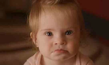 Down Sendromu Genetik Midir? Down Sendromu Genetik Midir?