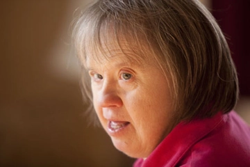 Down Sendromu Türleri ve Özellikleri Down Sendromu Türleri ve Özellikleri